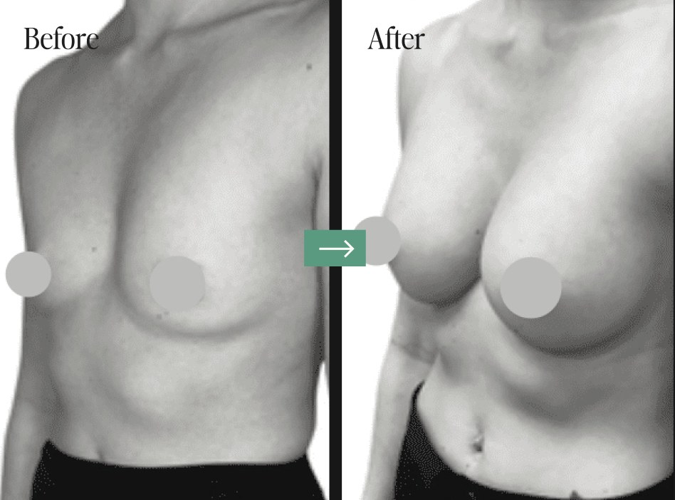 Breast Augmentation Before and After Pictures Charleston, SC